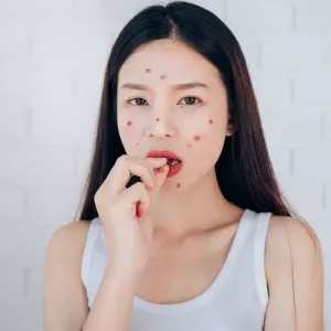 El chocolate ¿Realmente Causa Acné?.jpg